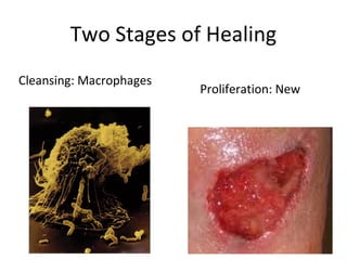Two Stages of Healing
Cleansing: Macrophages
                         Proliferation: New
cleanse the wound
                         connective
                         tissue is synthesized
 