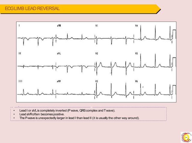 Module 2 interpreting ecg rythm strips-1-converted | PPTX