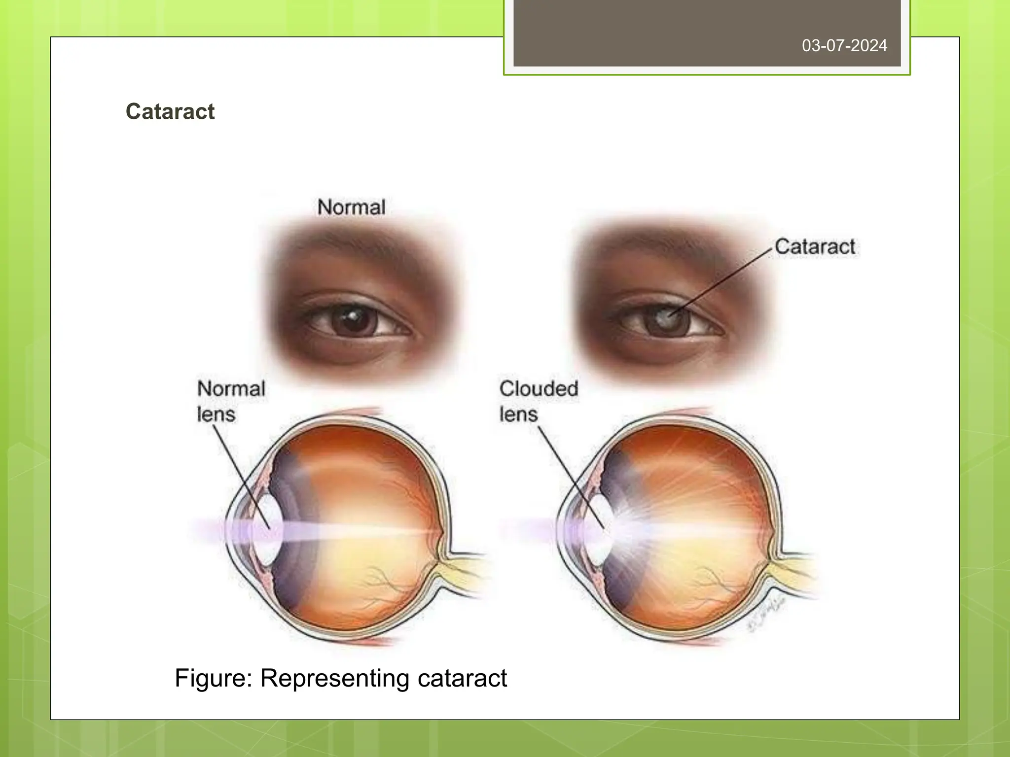 Cataract
03-07-2024
Figure: Representing cataract
 