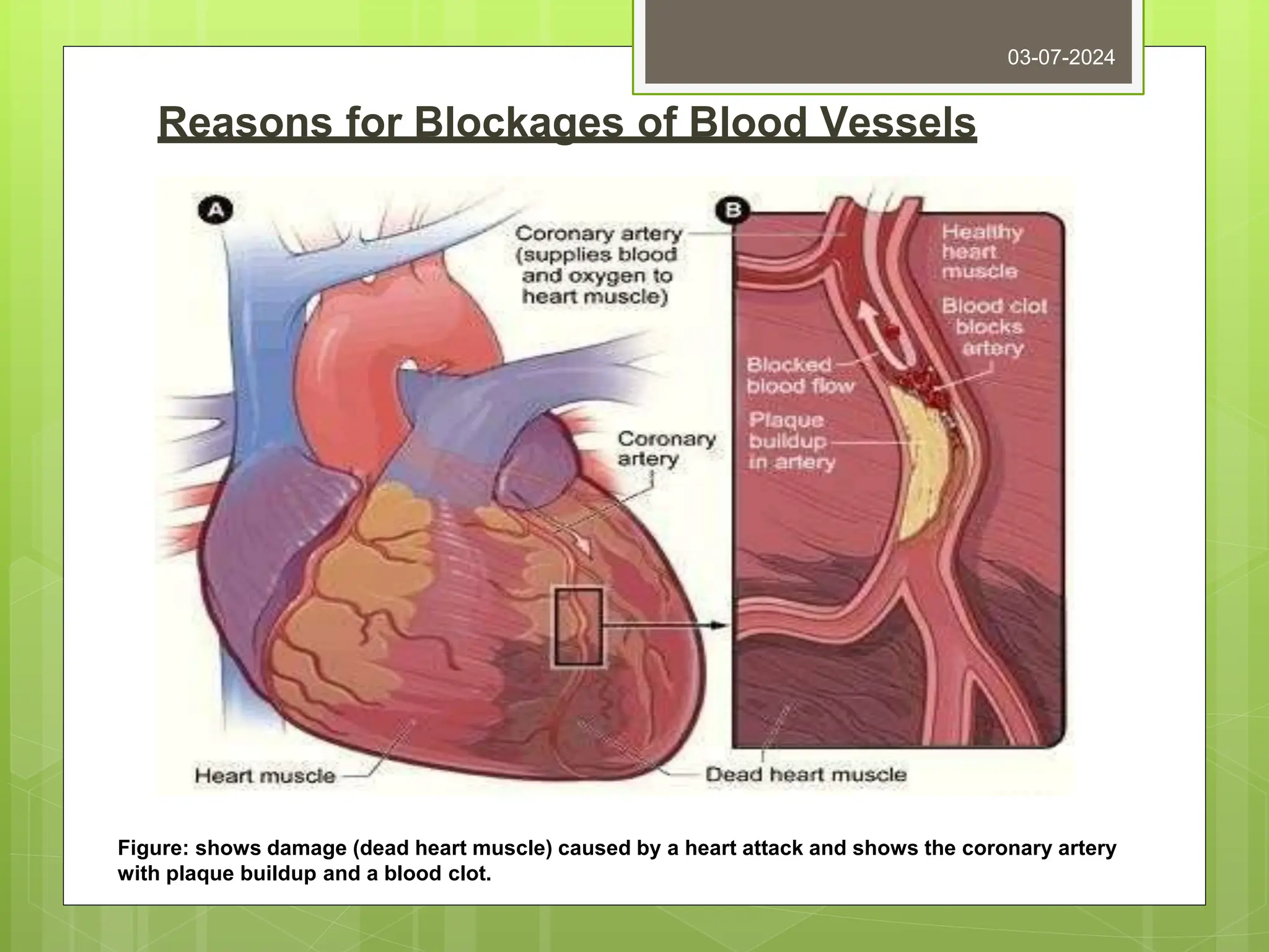 Reasons for Blockages of Blood Vessels
03-07-2024
Figure: shows damage (dead heart muscle) caused by a heart attack and shows the coronary artery
with plaque buildup and a blood clot.
 