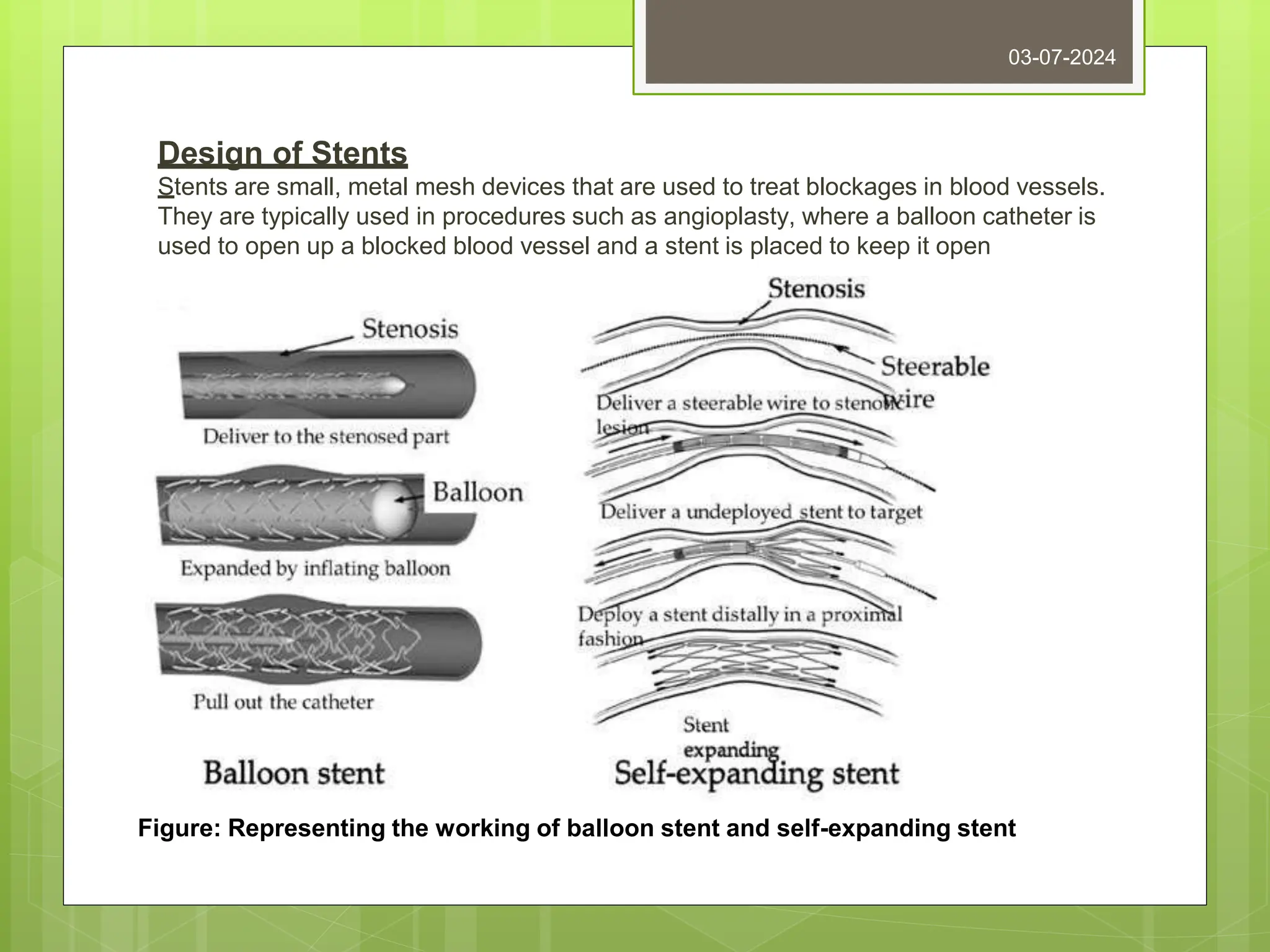Design of Stents
Stents are small, metal mesh devices that are used to treat blockages in blood vessels.
They are typically used in procedures such as angioplasty, where a balloon catheter is
used to open up a blocked blood vessel and a stent is placed to keep it open
03-07-2024
Figure: Representing the working of balloon stent and self-expanding stent
 