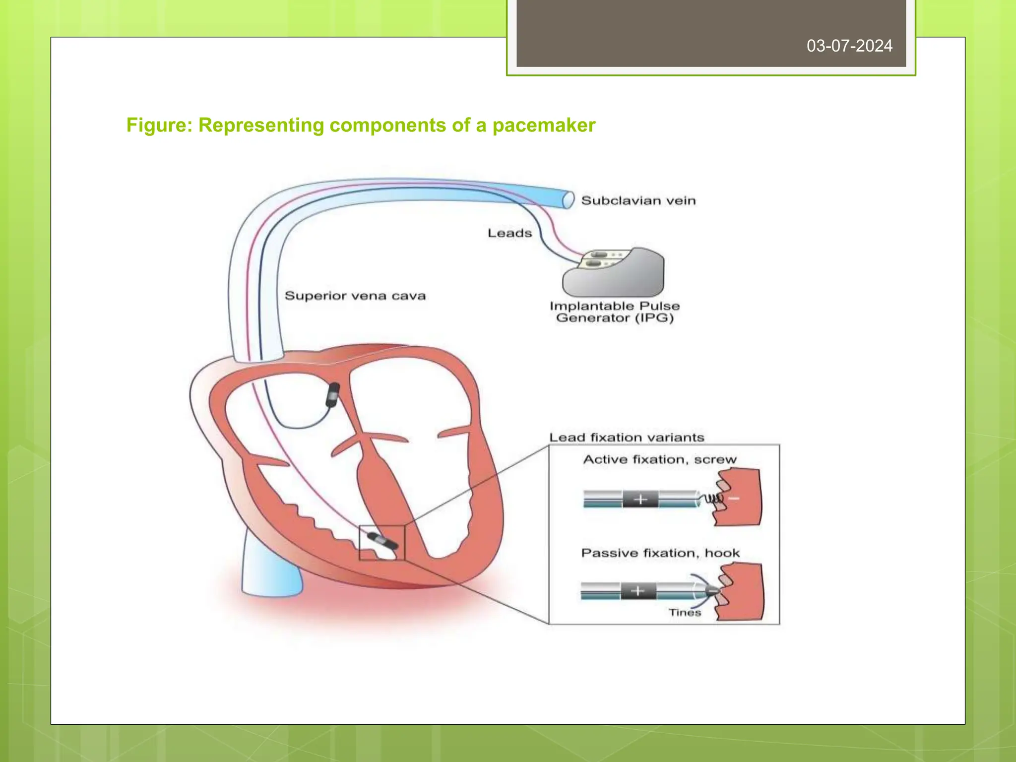 Figure: Representing components of a pacemaker
03-07-2024
 