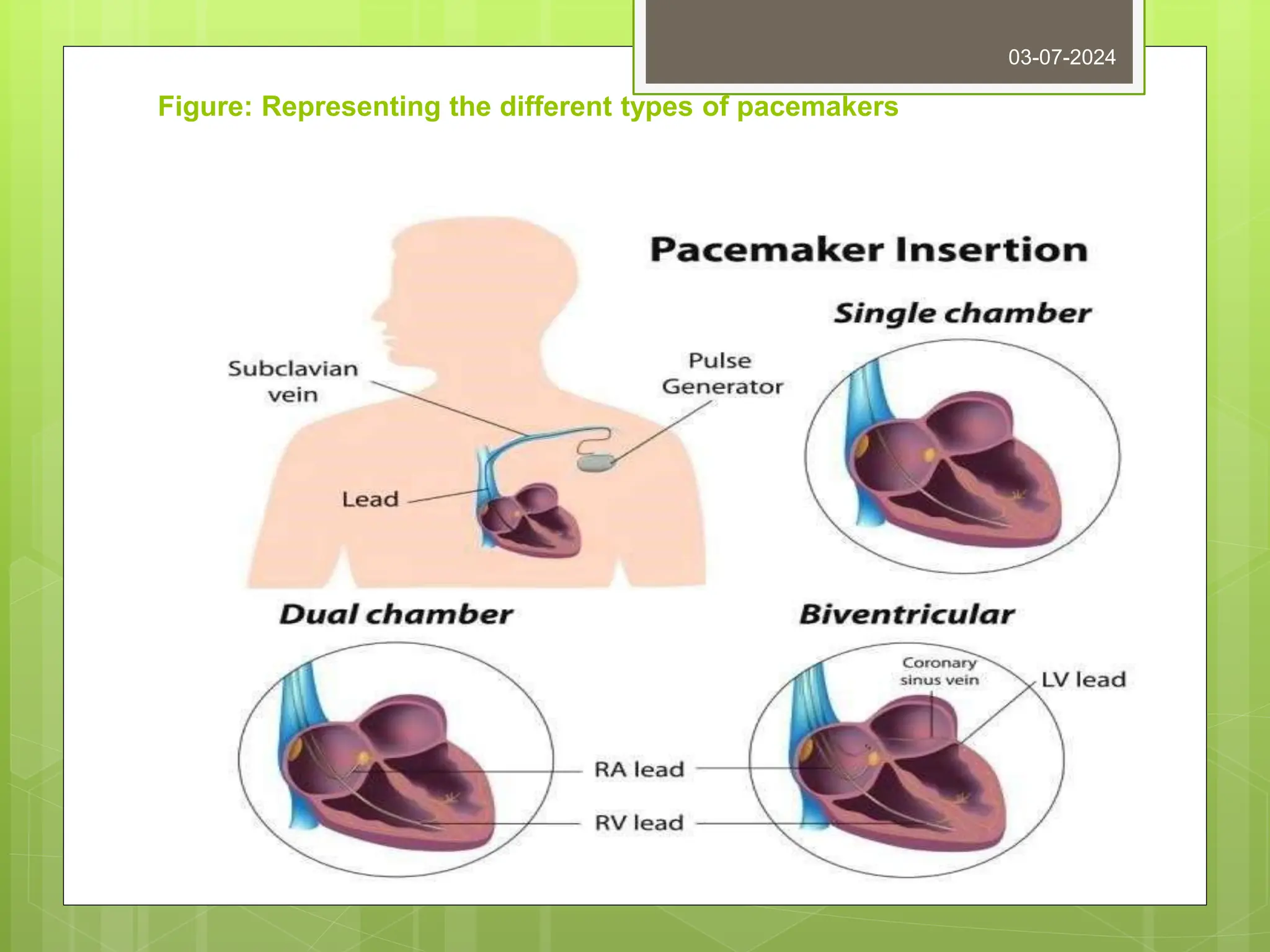 Figure: Representing the different types of pacemakers
03-07-2024
 