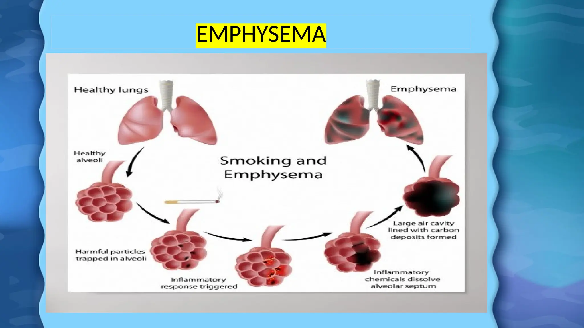 EMPHYSEMA
 