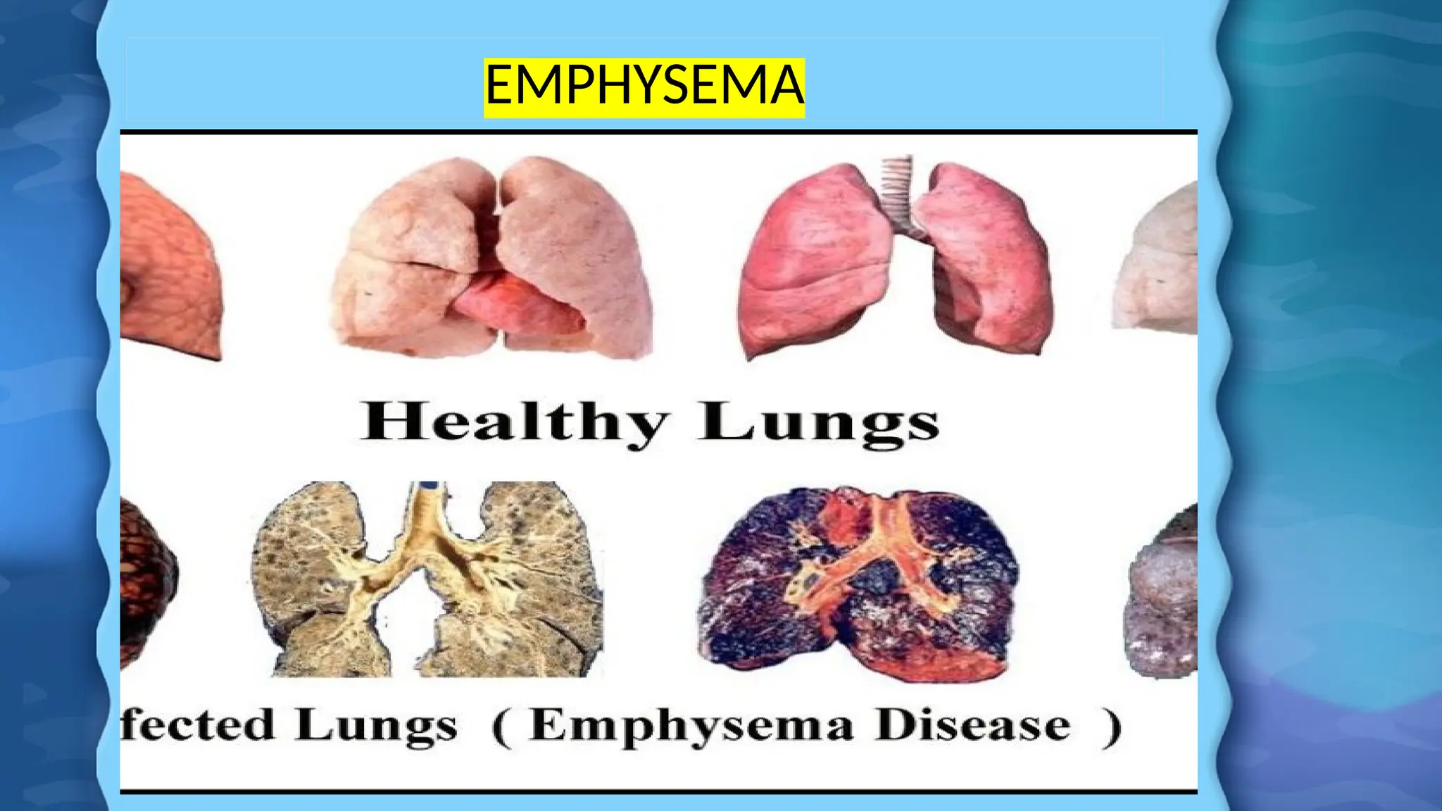 EMPHYSEMA
 