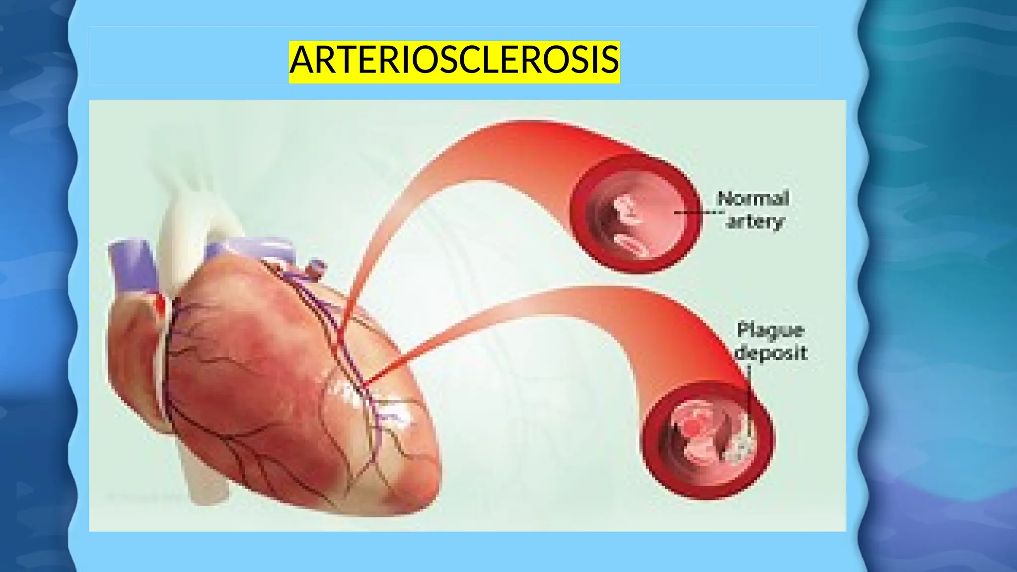 ARTERIOSCLEROSIS
 