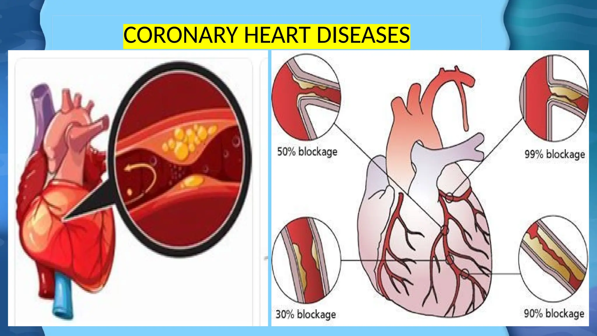 CORONARY HEART DISEASES
 