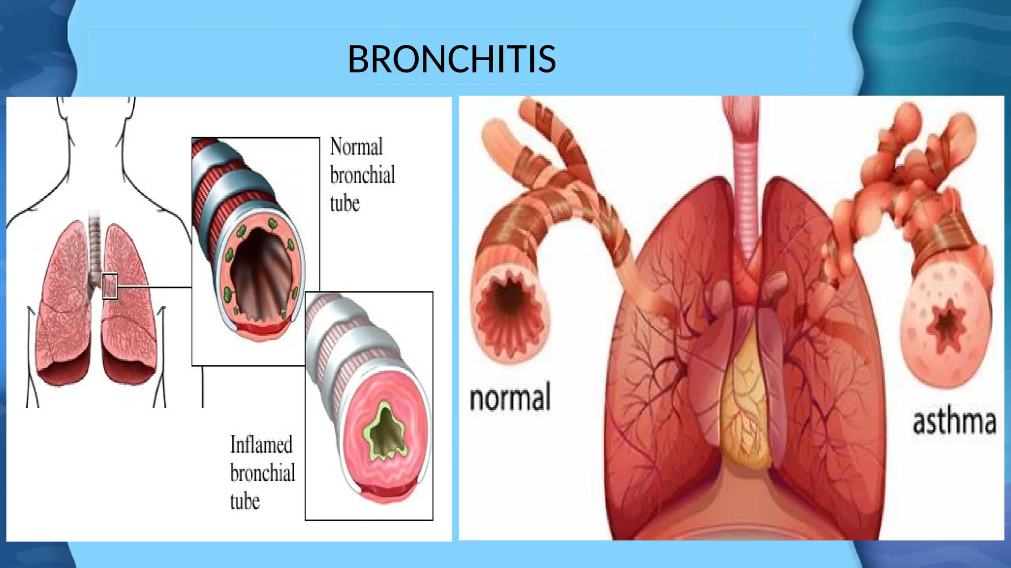 BRONCHITIS
 