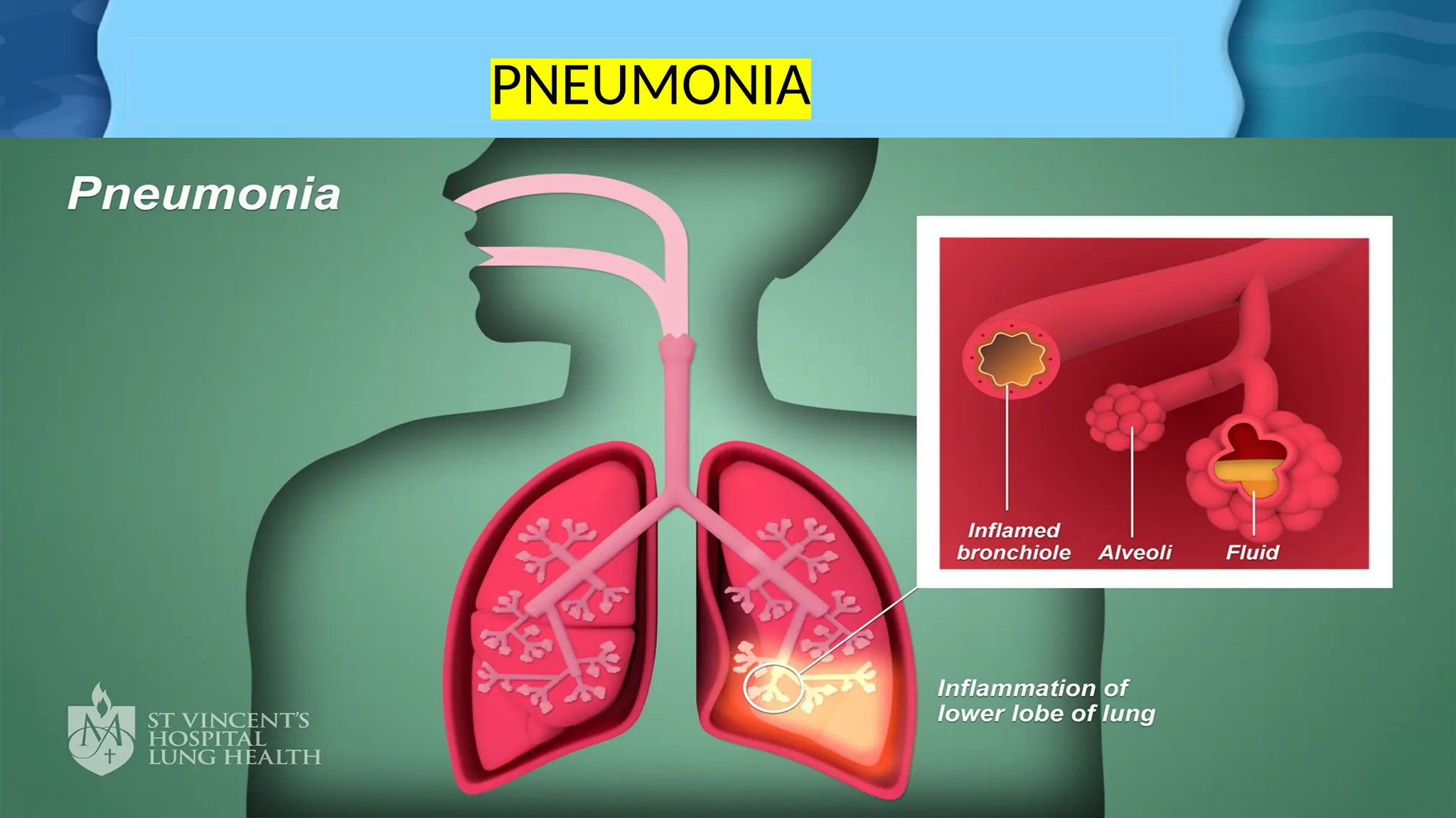 PNEUMONIA
 