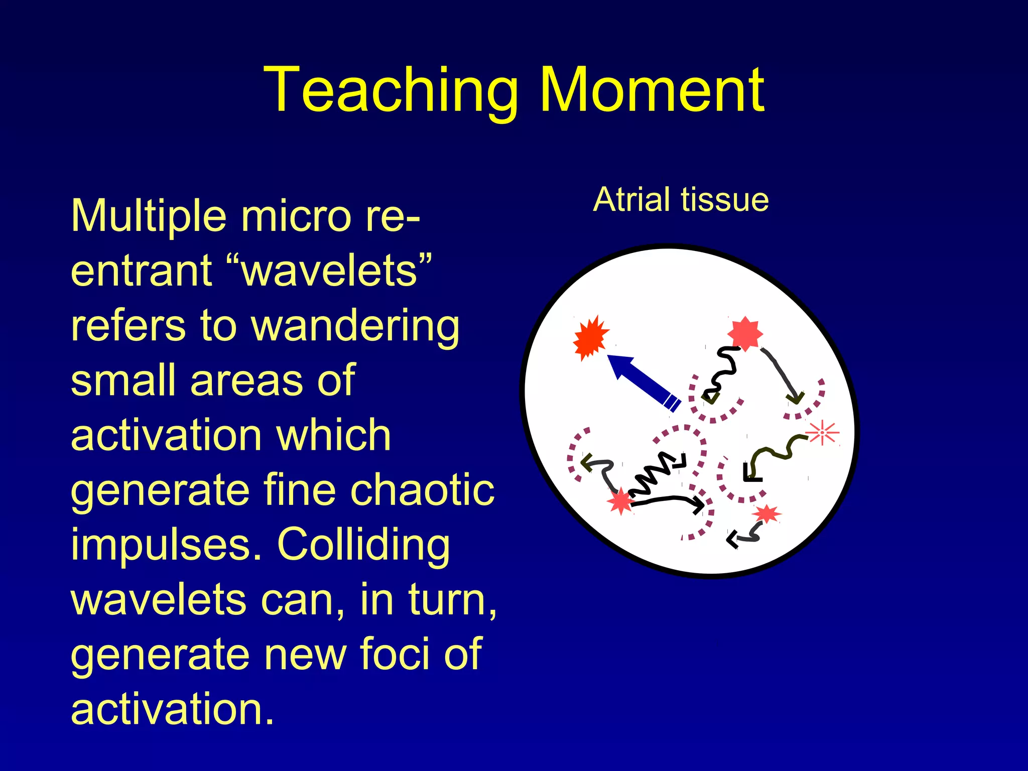 Teaching Moment
Multiple micro re-
entrant “wavelets”
refers to wandering
small areas of
activation which
generate fine chaotic
impulses. Colliding
wavelets can, in turn,
generate new foci of
activation.
Atrial tissue
 