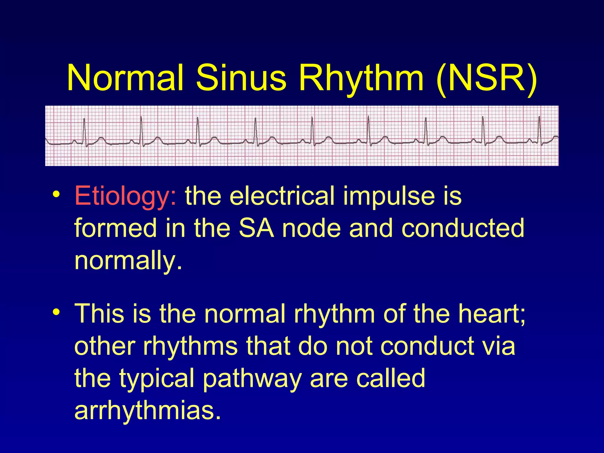 Normal Sinus Rhythm (NSR)
• Etiology: the electrical impulse is
formed in the SA node and conducted
normally.
• This is the normal rhythm of the heart;
other rhythms that do not conduct via
the typical pathway are called
arrhythmias.
 