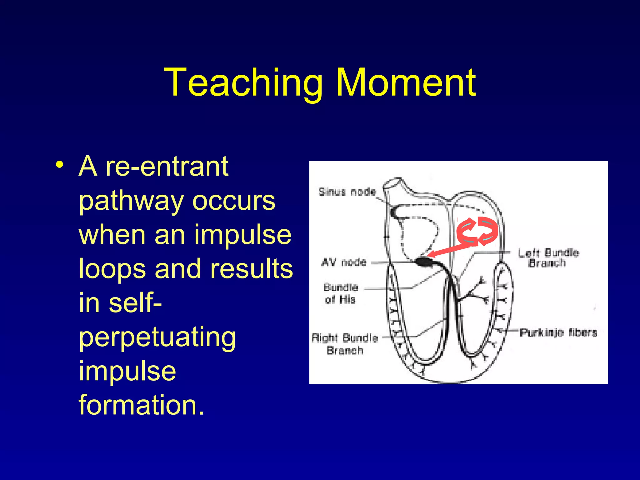 Teaching Moment
• A re-entrant
pathway occurs
when an impulse
loops and results
in self-
perpetuating
impulse
formation.
 