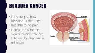BLADDER CANCER
• Early stages show
bleeding in the urine
but little to no pain
• Hematuria is the first
sign of bladder cancer,
followed by changes in
urination
 