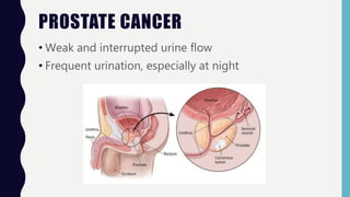 PROSTATE CANCER
• Weak and interrupted urine flow
• Frequent urination, especially at night
 