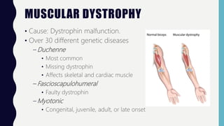MUSCULAR DYSTROPHY
• Cause: Dystrophin malfunction.
• Over 30 different genetic diseases
– Duchenne
• Most common
• Missing dystrophin
• Affects skeletal and cardiac muscle
– Fascioscapulohumeral
• Faulty dystrophin
– Myotonic
• Congenital, juvenile, adult, or late onset
 