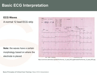 Components of the Gradian CCV SystemBasic ECG Interpretation
ECG Waves
A normal 12 lead ECG strip
Note: the waves have a certain
morphology based on where the
electrode is placed
Basic Principles of Critical Care Training I Basic ECG Interpretation
https://commons.wikimedia.org/wiki/File:Normal_12_lead_EKG.jpg#/media/File:Normal_12_lead_EKG.jpg
 