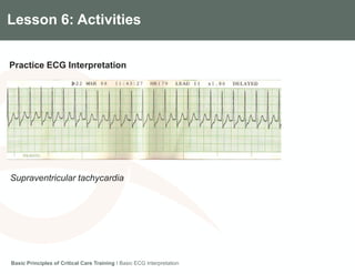 Components of the Gradian CCV SystemLesson 6: Activities
Practice ECG Interpretation
Basic Principles of Critical Care Training I Basic ECG Interpretation
Supraventricular tachycardia
 