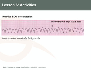 Components of the Gradian CCV SystemLesson 6: Activities
Practice ECG Interpretation
Basic Principles of Critical Care Training I Basic ECG Interpretation
Monomorphic ventricular tachycardia
 