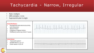 Tachycardia - Narrow, Irregular
• Rate >100bpm
• QRS complex < 0.12s
• Supraventricular in origin
Atrial Fibrillation
• Disorganized atrial electrical activity
and contraction
• Absent P Wave
• Irregularly, irregular rhythm
• Fibrillatory waves may mimic P waves
Atrial flutter
• ‘Sawtooth’ pattern
• Variable block i.e. 4:1, 3:1
• Flutter waves in II,III, aV
 