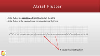 Atrial Flutter
▪ Atrial flutter is a coordinated rapid beating of the atria
▪ Atrial flutter is the second most common tachyarrhythmia
F waves in sawtooth pattern
 