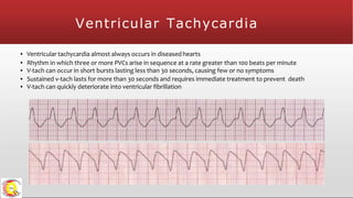 Ventricular Tachycardia
▪ Ventricular tachycardia almost always occurs in diseased hearts
▪ Rhythm in which three or more PVCs arise in sequence at a rate greater than 100 beats per minute
▪ V-tach can occur in short bursts lasting less than 30 seconds, causing few or no symptoms
▪ Sustained v-tach lasts for more than 30 seconds and requires immediate treatment to prevent death
▪ V-tach can quickly deteriorate into ventricular fibrillation
 