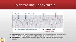 • Capture beats — occur when the sinoatrial node transiently ‘captures’ the ventricles, in the
midst of AV dissociation, to produce a QRS complex of normal duration
• Fusion beats — occur when a sinus and ventricular beat coincides to produce a hybrid
complex
Ventricular Tachycardia
 