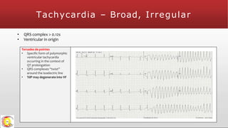 Tachycardia – Broad, Irregular
• QRS complex > 0.12s
• Ventricular in origin
Torsades de pointes
• Specific form of polymorphic
ventricular tachycardia
occurring in the context of
QT prolongation
• QRS complexes “twist”
around the isoelectric line
• TdP may degenerate into VF
 