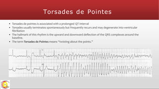 Torsades de Pointes
▪ Torsades de pointes is associated with a prolonged QT interval
▪ Torsades usually terminates spontaneously but frequently recurs and may degenerate into ventricular
fibrillation
▪ The hallmark of this rhythm is the upward and downward deflection of the QRS complexes around the
baseline.
▪ The term Torsades de Pointes means “twisting about the points.”
 