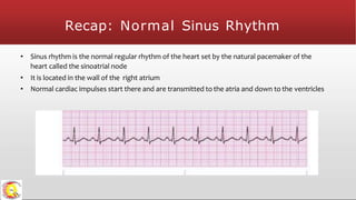 Recap: Normal Sinus Rhythm
• Sinus rhythm is the normal regular rhythm of the heart set by the natural pacemaker of the
heart called the sinoatrial node
• It is located in the wall of the right atrium
• Normal cardiac impulses start there and are transmitted to the atria and down to the ventricles
 