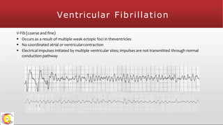Ventricular Fibrillation
V-Fib (coarse and fine)
 Occurs as a result of multiple weak ectopic foci in theventricles
 No coordinated atrial or ventricularcontraction
 Electrical impulses initiated by multiple ventricular sites; impulses are not transmitted through normal
conduction pathway
 