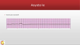 Asysto le
▪ Ventricular standstill
 