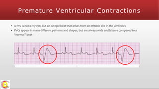 Premature Ventricular Contractions
▪ A PVC is not a rhythm, but an ectopic beat that arises from an irritable site in the ventricles
▪ PVCs appear in many different patterns and shapes, but are always wide and bizarre compared to a
“normal” beat
 