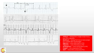 • Unifocal — Arising from a single ectopic focus;
each PVC is identical
• Multifocal — Arising from two or more ectopic
foci; multiple QRS morphologies
• Bigeminy — every other beat is a PVC
• Trigeminy — every third beat is a PVC
• Quadrigeminy — every fourth beat is a PVC
• Couplet — two consecutive PVCs
• NSVT — three-thirty consecutive PVCs
 