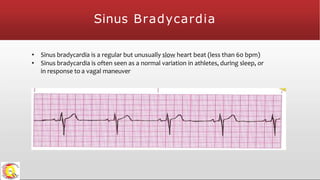 Sinus Bradycardia
• Sinus bradycardia is a regular but unusually slow heart beat (less than 60 bpm)
• Sinus bradycardia is often seen as a normal variation in athletes, during sleep, or
in response to a vagal maneuver
 