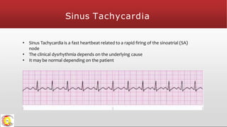 Sinus Tachycardia
• Sinus Tachycardia is a fast heartbeat related to a rapid firing of the sinoatrial (SA)
node
• The clinical dysrhythmia depends on the underlying cause
• It may be normal depending on the patient
 