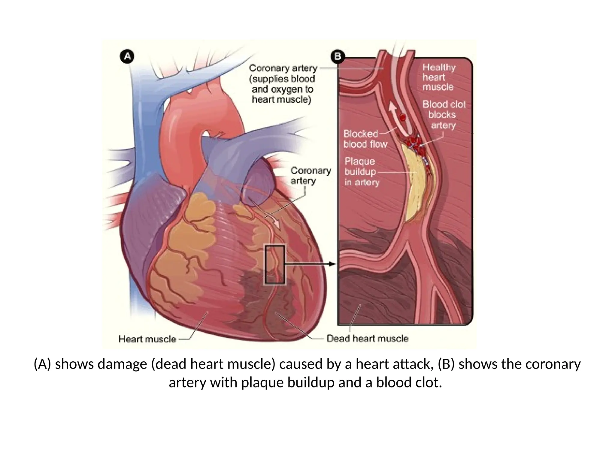 (A) shows damage (dead heart muscle) caused by a heart attack, (B) shows the coronary
artery with plaque buildup and a blood clot.
 