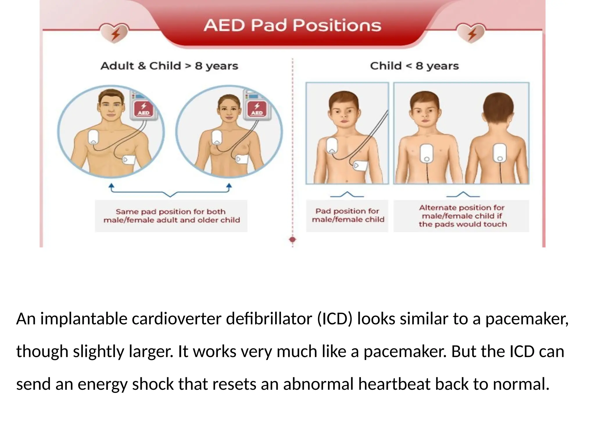 An implantable cardioverter defibrillator (ICD) looks similar to a pacemaker,
though slightly larger. It works very much like a pacemaker. But the ICD can
send an energy shock that resets an abnormal heartbeat back to normal.
 