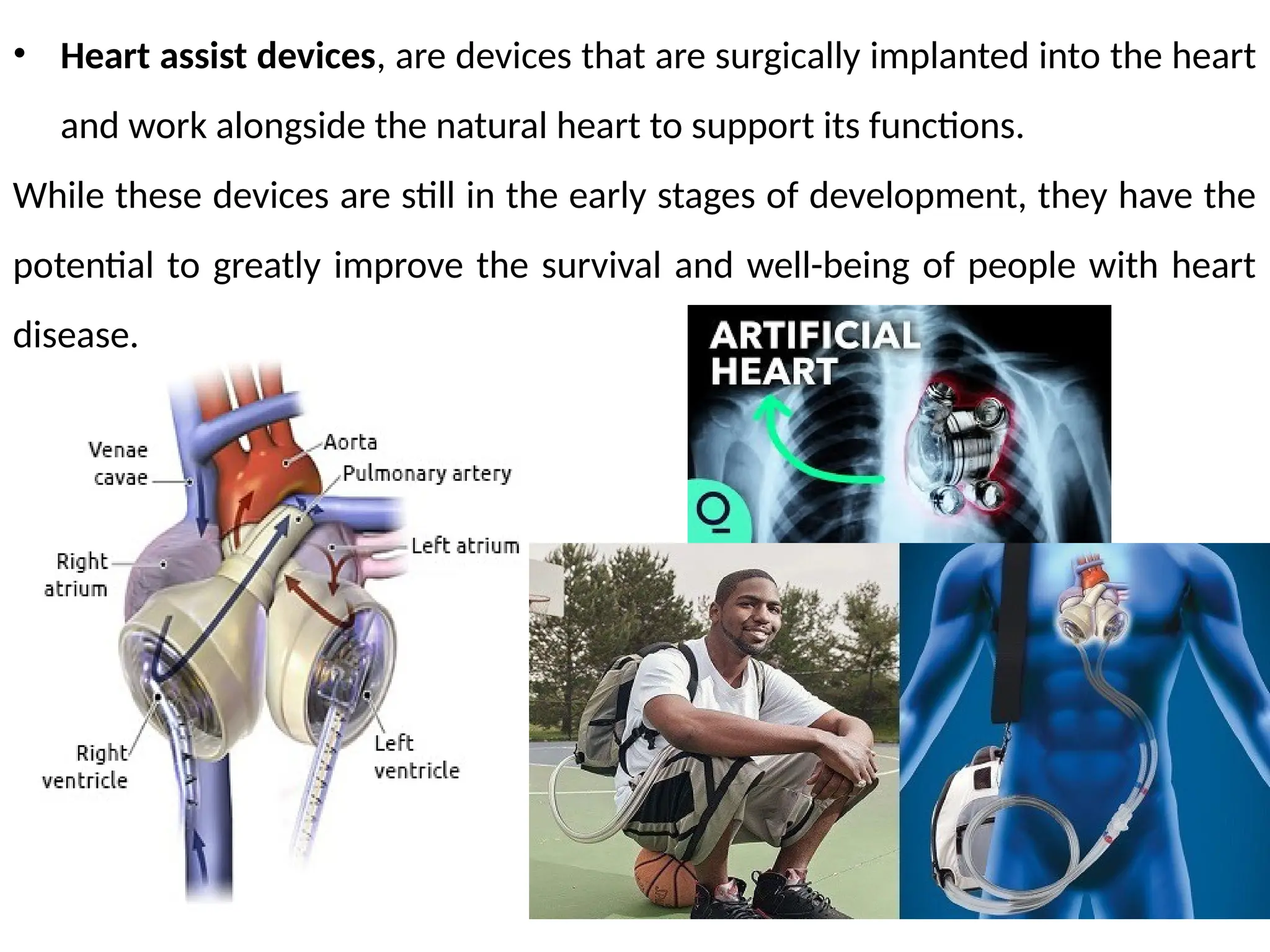 • Heart assist devices, are devices that are surgically implanted into the heart
and work alongside the natural heart to support its functions.
While these devices are still in the early stages of development, they have the
potential to greatly improve the survival and well-being of people with heart
disease.
 