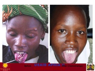 Aids Patient Before And After