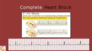 Module 4 av block and bradyarrythmias-1 | PPTX