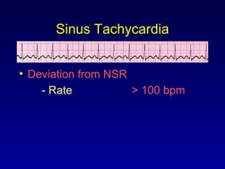 Sinus Tachycardia
• Deviation from NSR
- Rate > 100 bpm
 