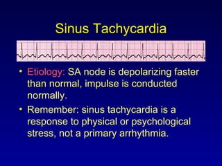 Sinus Tachycardia
• Etiology: SA node is depolarizing faster
than normal, impulse is conducted
normally.
• Remember: sinus tachycardia is a
response to physical or psychological
stress, not a primary arrhythmia.
 