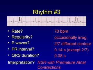Rhythm #3
70 bpm• Rate?
• Regularity? occasionally irreg.
2/7 different contour
0.08 s
• P waves?
• PR interval? 0.14 s (except 2/7)
• QRS duration?
Interpretation? NSR with Premature Atrial
Contractions
 