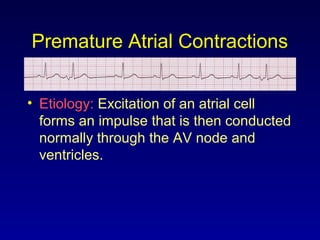 Premature Atrial Contractions
• Etiology: Excitation of an atrial cell
forms an impulse that is then conducted
normally through the AV node and
ventricles.
 