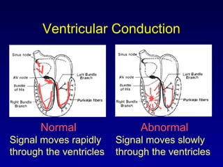 Ventricular Conduction
Normal
Signal moves rapidly
through the ventricles
Abnormal
Signal moves slowly
through the ventricles
 