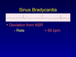 Sinus Bradycardia
• Deviation from NSR
- Rate < 60 bpm
 