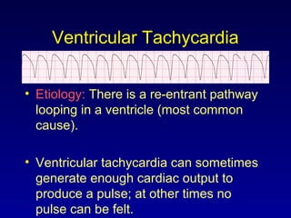 Ventricular Tachycardia
• Etiology: There is a re-entrant pathway
looping in a ventricle (most common
cause).
• Ventricular tachycardia can sometimes
generate enough cardiac output to
produce a pulse; at other times no
pulse can be felt.
 