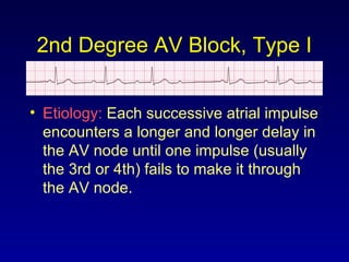 2nd Degree AV Block, Type I
• Etiology: Each successive atrial impulse
encounters a longer and longer delay in
the AV node until one impulse (usually
the 3rd or 4th) fails to make it through
the AV node.
 