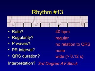 Rhythm #13
40 bpm• Rate?
• Regularity? regular
no relation to QRS
wide (> 0.12 s)
• P waves?
• PR interval? none
• QRS duration?
Interpretation? 3rd Degree AV Block
 