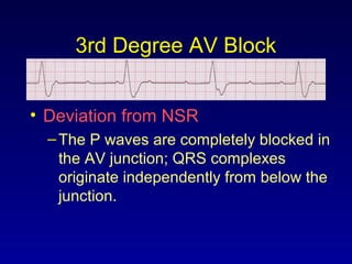 3rd Degree AV Block
• Deviation from NSR
–The P waves are completely blocked in
the AV junction; QRS complexes
originate independently from below the
junction.
 